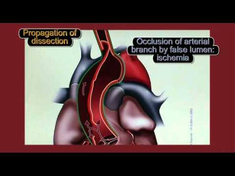 Rozwarstwienie aorty- patofizjologia