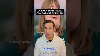 🦷😇 QUERUBISMO: la enfermedad rara que da “cara de ángel”