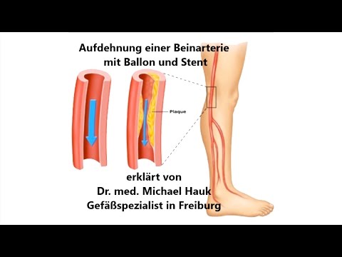 Geschwollene Gelenke in der Hand Preis Implantate für die Gelenke