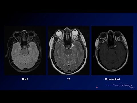 Neuroradiology Board Review - Brain Tumors - Case 8