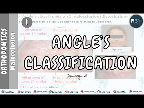 Angle's Classification of Malocclusion | Dr Paridhi Agrawal