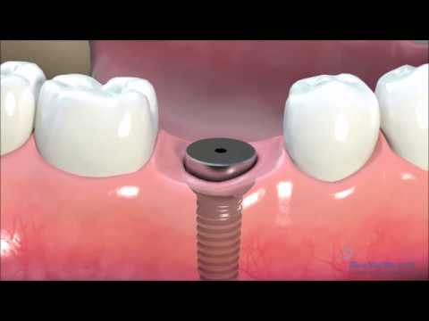 2-Stage Dental Implant Procedure