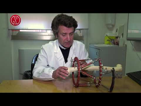 La risposta dell'Esperto - Ortopedia pediatrica: deformità degli arti inferiori