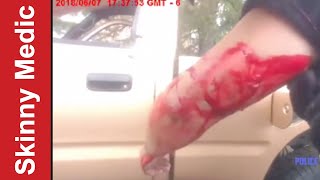 Cop Applies Tourniquet to Suspect&#39;s Arm (After Action Medical Report)