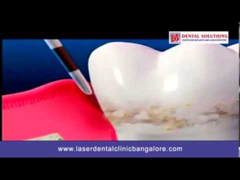 Gingivitis Cure Bangalore | Gum Disease Treatment Bangalore