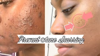 Skin | How to Prevent Acne Scarring | Shanese Danae