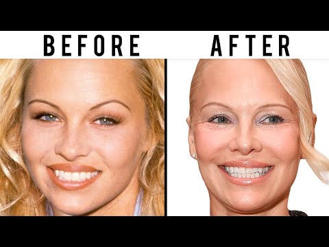 Has Pamela Anderson Had Plastic Surgery? | Plastic Surgery Analysis