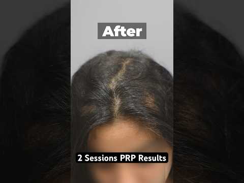 PRP Results Before & After 2 Sessions  #prptreatment #hairlosstreatment