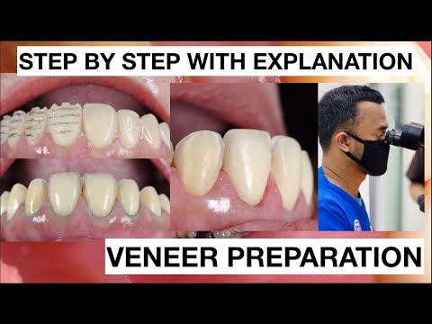 Step by Step Minimally Invasive Veneers Preparation