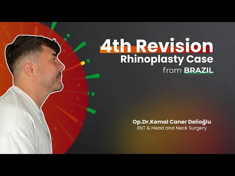 Revision Rhinoplasty Patient Story: From 3 Failed Surgeries to a Masculine Nose