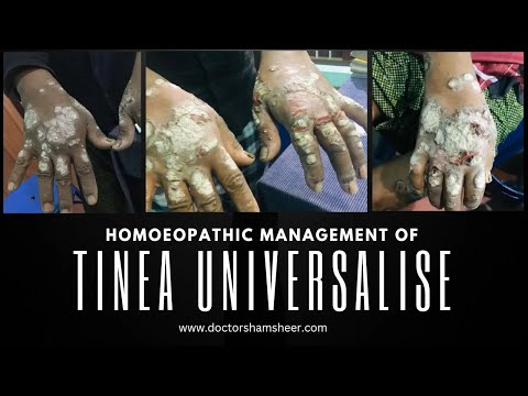 Tinea universalise or Tinea corporis-a difficult case I had faced at the beginning time of my practice