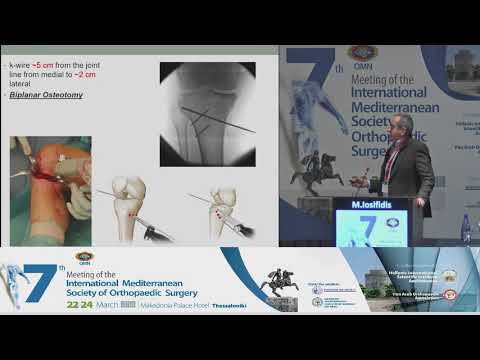 M. Iosifidis - Patellofemoral joint, ACL and malalignment