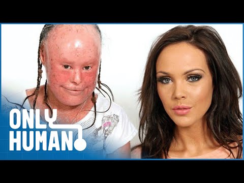 A Glamour Model & A Woman With Facial Disfigurements Meet: The Ugly Face of Prejudice | Only Human