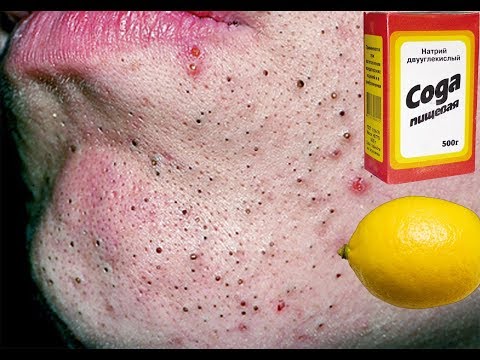 Отбеливающая маска для лица на всю ночь Лазерное удаление веснушек ростов