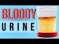 11 causes for blood in the urine | Hematuria
