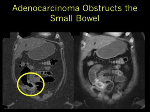 CT Evaluation of Small Bowel Obstruction Part 2