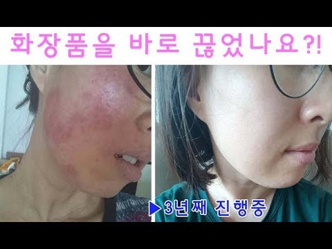 화장품을 바로 끊었나요? 물로만 세안하기 3년차/화장품안쓰기/접촉성피부염 극복