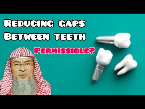 Is closing gaps between teeth permissible? - Assim al hakeem