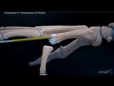 Compression FT Intramedullary FX Fixation