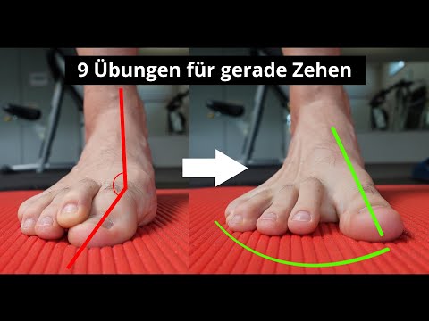 Hallux Valgus for Beginners - 9 Exercises for Straight Toes