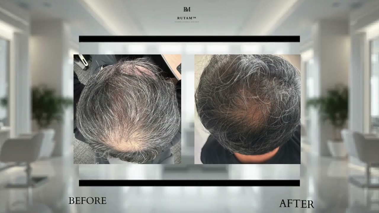 RUTAM Bio-Functional Scalp System