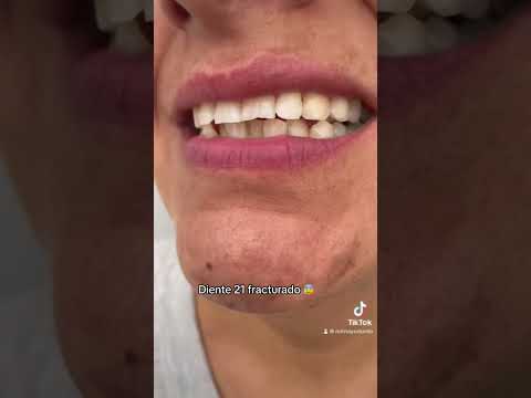 Diente fracturado 🦷🎃 #shorts #dientes #short