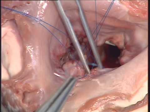 Mitral Valve Repair Quadrangular resection and Carpentier repair