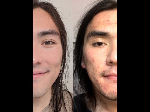 Accutane Transformation Timelapse #shorts
