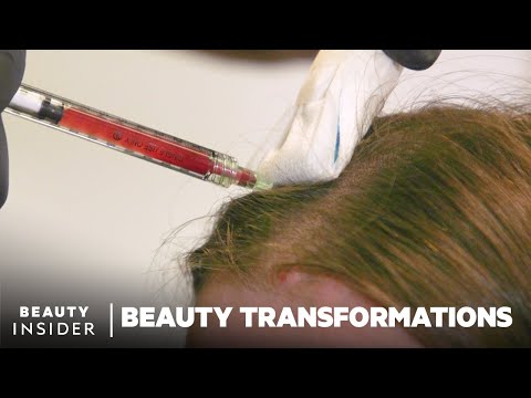 How To Restore Hair Growth With Platelet-Rich Fibrin | Beauty Transformations