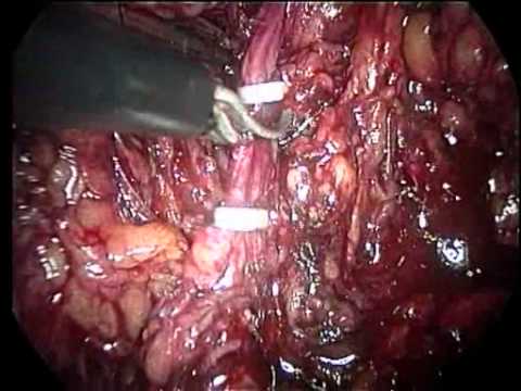 Neobladder And Supra-Ampullar Technique Of Cystectomy