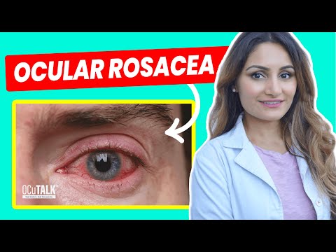 Ocular Rosacea and Dry Eye | How can rosacea affect your eyes?