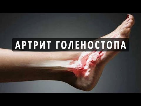 Межпозвонковая грыжа и боли в пояснице Методы лечения при растяжении коленного сустава