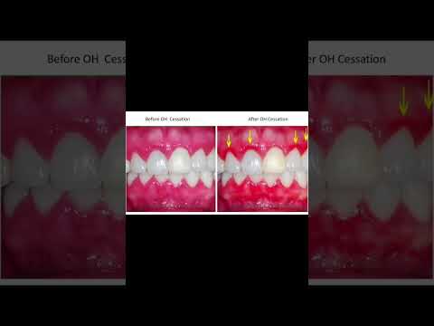 Experimental Gingivitis Induction Methods – Video abstract 564132]