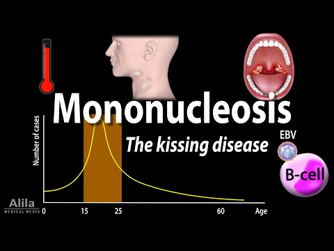 Infectious Mononucleosis (Mono) - the Kissing Disease, Animation