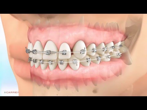 Carriere® Motion™  Appliance for Class II Patient Education Animation