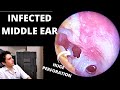 The Worst Ear Infection (Suppurative Otitis Media)