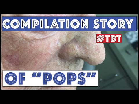 "Pops" and his BEST blackhead extractions - TBT