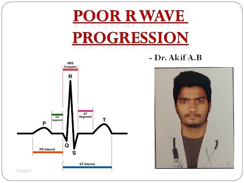 POOR R WAVE PROGRESSION -ECG