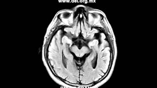 Resonancia magnética de cráneo - Diagnóstico Especializado por Imagen DEI