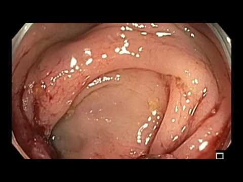 Colonoscopy: Sigmoid colon cancer
