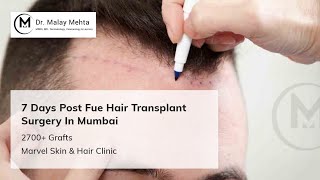 Avail FUE Hair Transplant Surgery By Specialist Dr.Malay Mehta