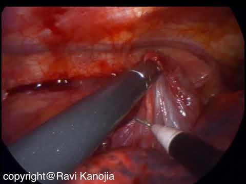 Mediastinal Bronchogenic Cyst in a 10 yr old Boy