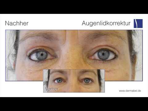 Zelestoderm vom Ekzem auf den Händen Zu wem, sich für die Behandlung des Ekzems zu wenden