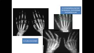 Artritis Reumatoidea: patogenia y diagnostico (Parte 2)