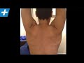 Irregular Scapulo-humeral Rhythm in Patient with left sided Sub-acromial Impingement