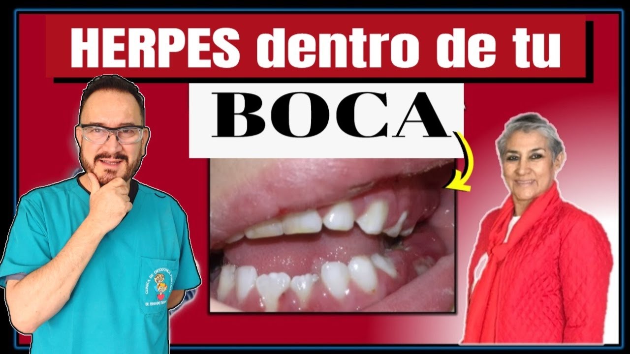 GINGIVOESTOMATITIS HERPÉTICA AGUDA / Virus Herpes Simple (VHS-1)