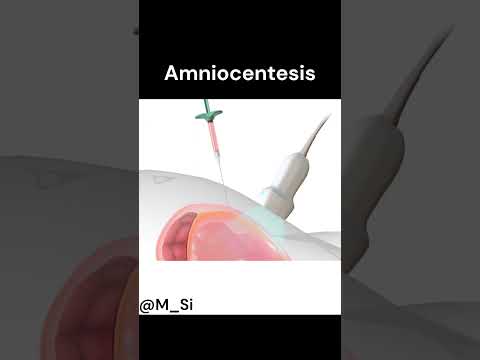 Amniocentesis