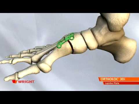 Wright - Ortholoc 3DI Lapidus Plate