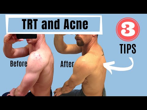 TRT and Acne - 3 Tips (Testosterone Replacement Therapy)