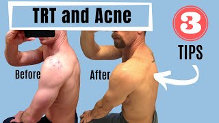 TRT and Acne - 3 Tips (Testosterone Replacement Therapy)